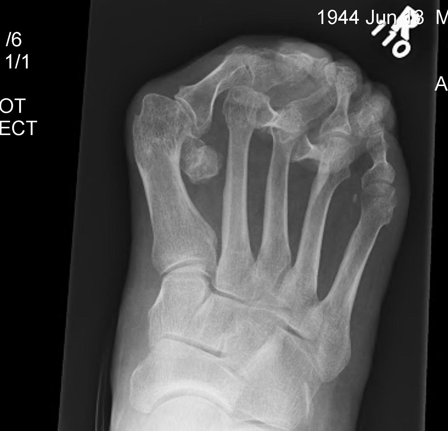 Hallux Valgus Severe Degenerative